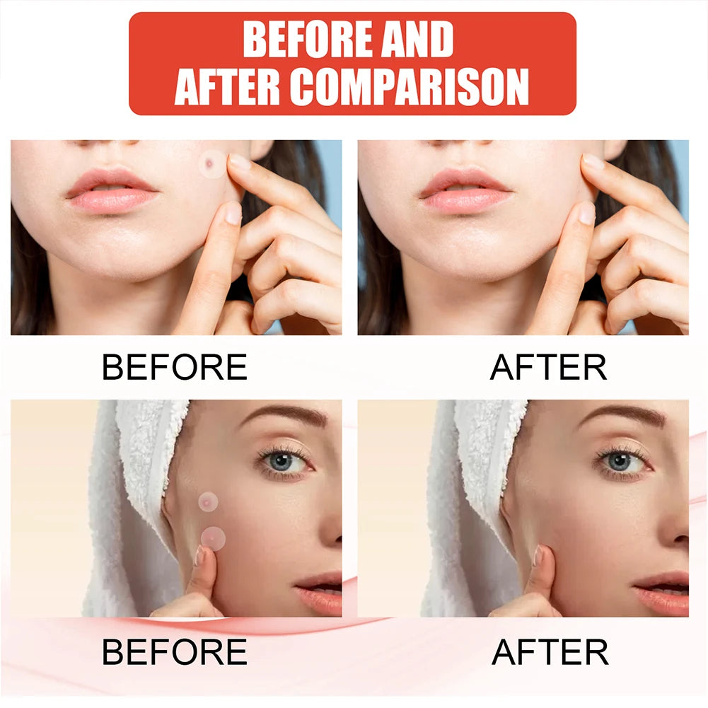 144pcs/set Face Skin Care Acne Pimple Patch 2 Sizes Invisible Professional Healing Absorbing Spot Sticker
